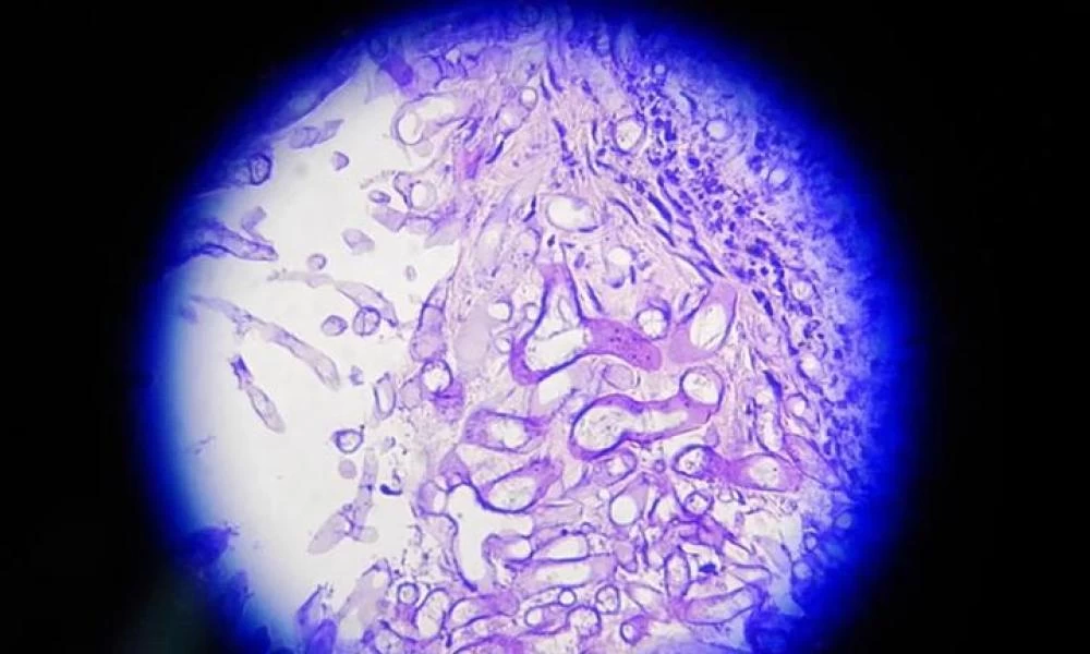 Ινδία: Σπάνια μόλυνση επιτίθεται σε ασθενείς με κορονοϊό